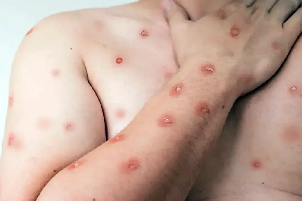 Estado tem cinco casos suspeitos de mpox, um em Santa Cruz de Goiás