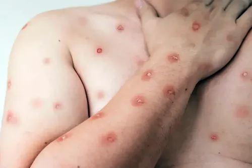 Estado tem cinco casos suspeitos de mpox, um em Santa Cruz de Goiás